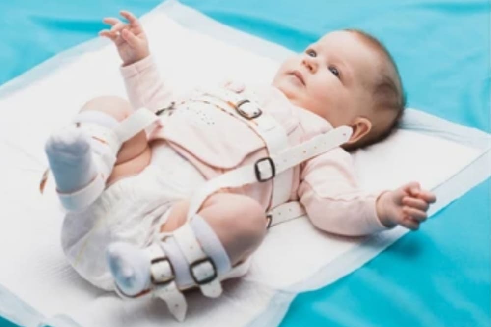 bebe acostado con ortesis para corrector de cadera en clinica